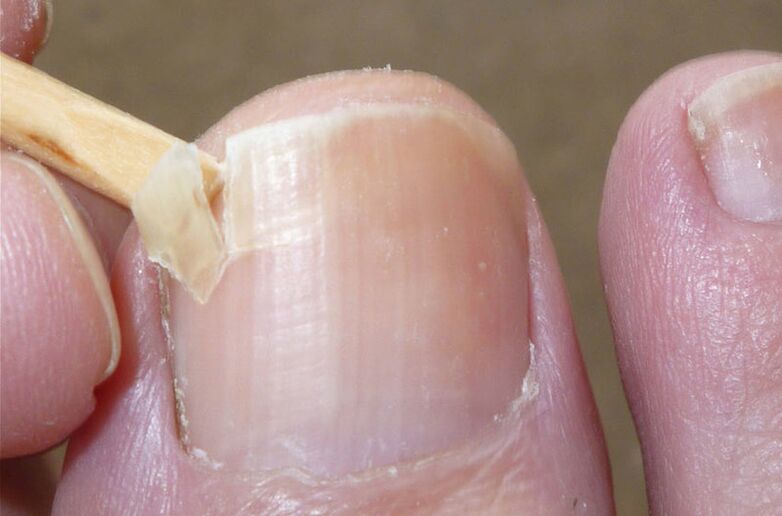 Les ongles abîmés sont un facteur de risque d'infections fongiques