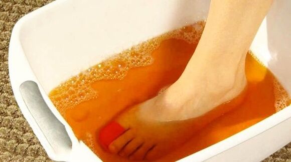 bain d'iode contre les mycoses des pieds