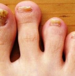 Le pied de la nog