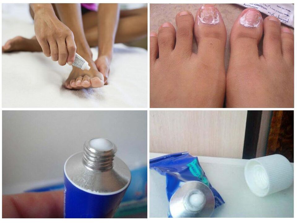 Préparations pharmaceutiques efficaces contre la mycose des ongles