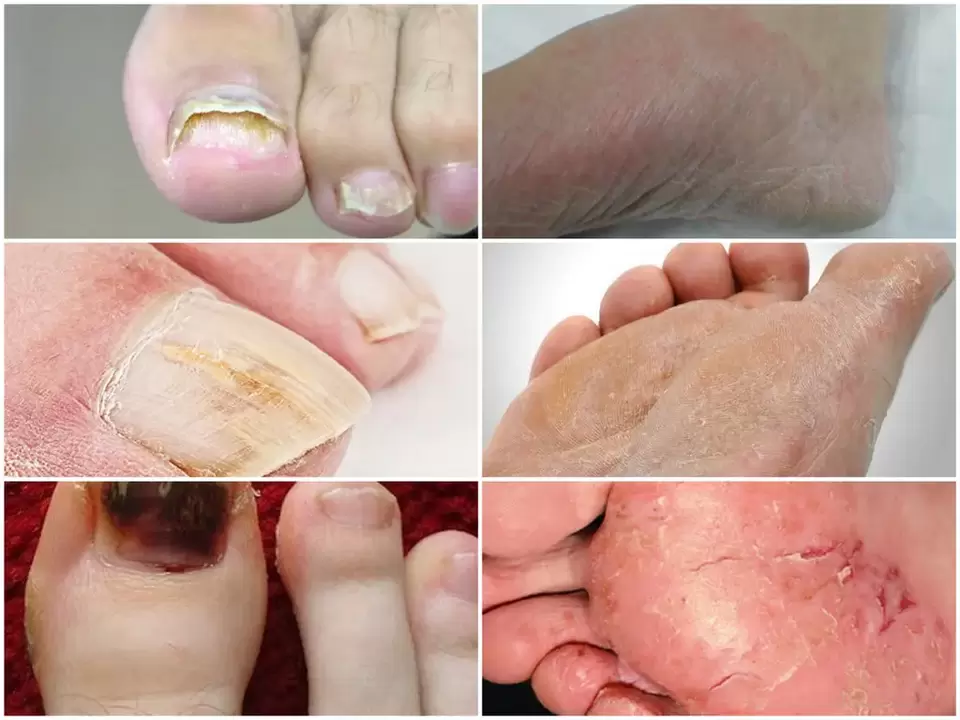 Manifestations de champignons sur les pieds provenant de divers agents pathogènes