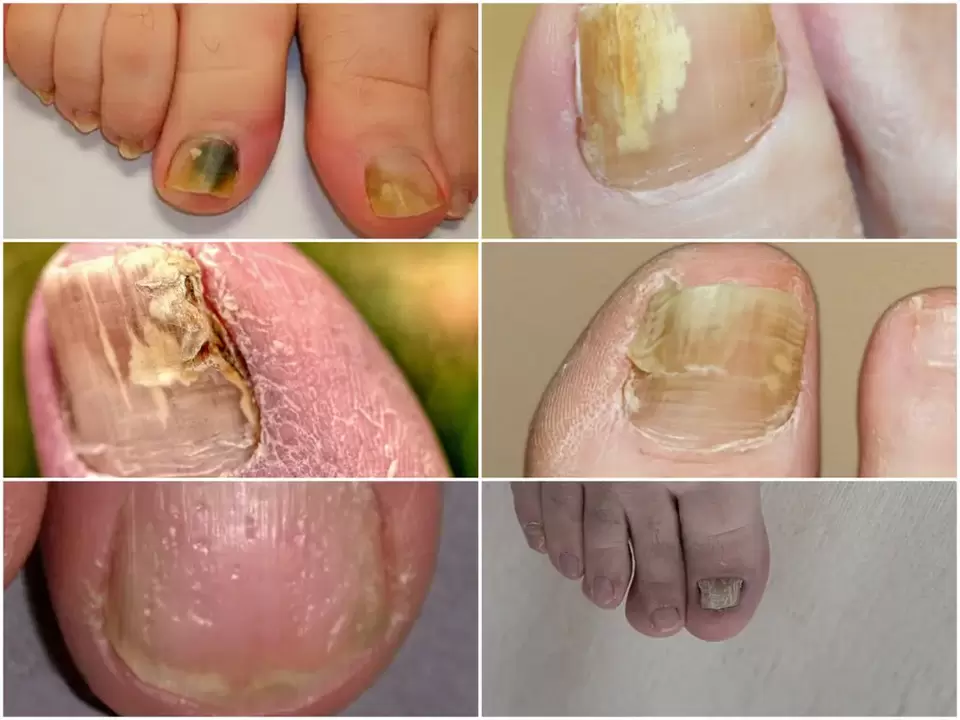 Symptômes de l'onychomycose, modifications de la couleur et de la structure des ongles