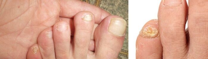 photos de manifestations de champignons sur les ongles des pieds