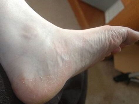 pelage du pied de la jambe comme signe d'infection fongique